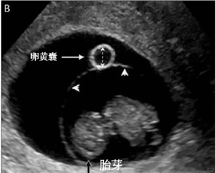 省三产科攻略：怀孕多久看到胎心胎芽？
