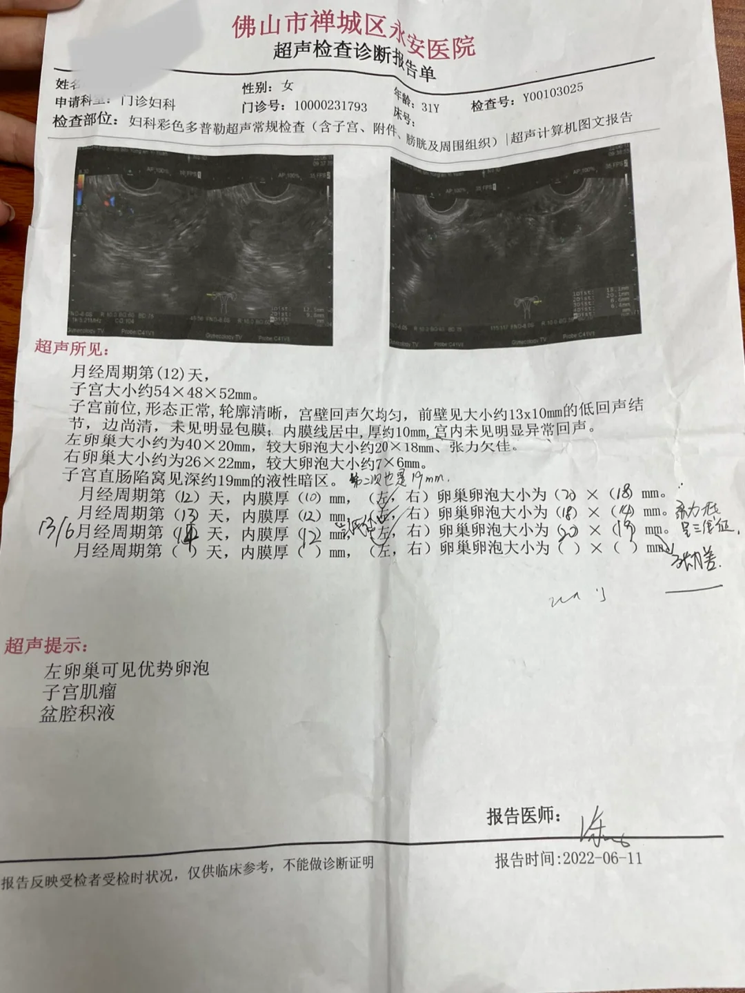 好烦呀，卵泡张力不好